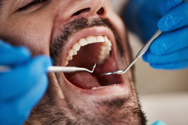 Best Wisdom Tooth Removal  in Henderson, TN